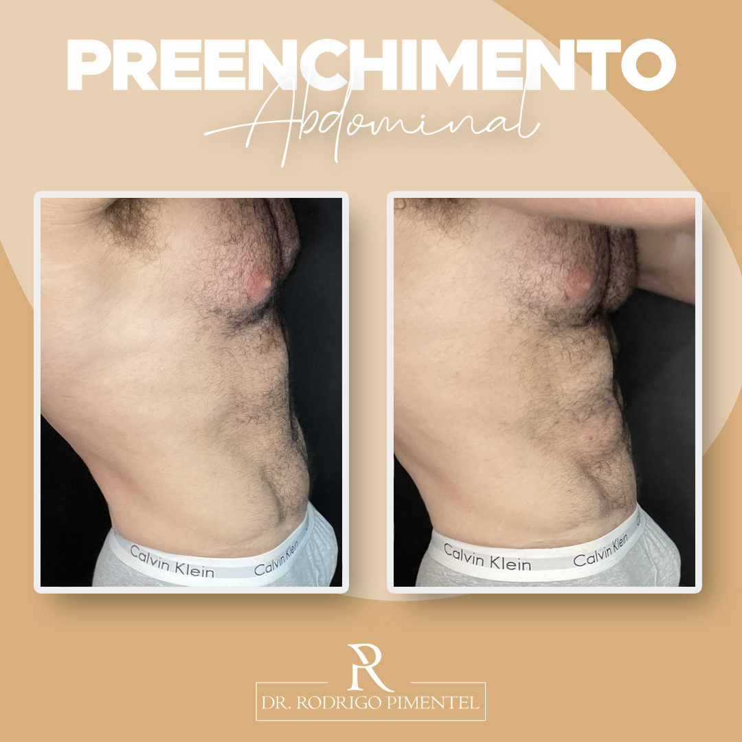 Preenchimento de Abdôme – Dr. Rodrigo Pimentel